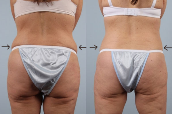 before and after coolsculpting back view female patient case 710