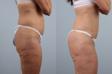 before and after coolsculpting right side view female patient case 710