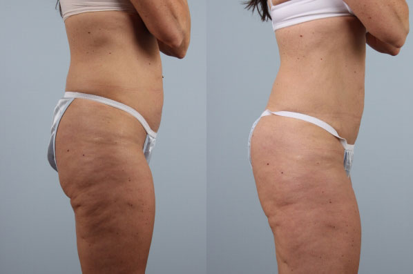 before and after coolsculpting right side view female patient case 710