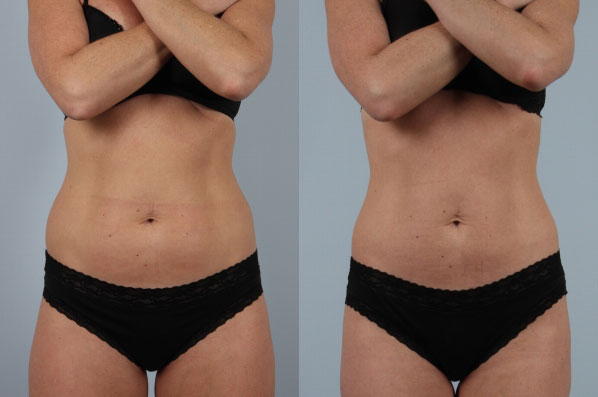 before and after coolsculpting front view female patient case 718