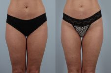 before and after coolsculpting front lower view female patient case 718