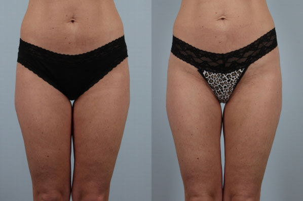 before and after coolsculpting front lower view female patient case 718