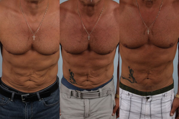before and after coolsculpting front stomach view male patient case 722