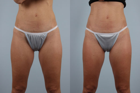 before and after coolsculpting front lower view female patient case 724