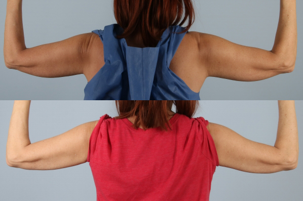 before and after coolsculpting back view female patient case 727