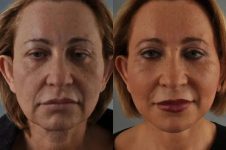 before and after facial fat grafting front view female patient case 1777