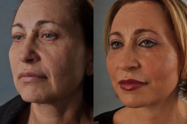 before and after facial fat grafting left angle view female patient case 1777