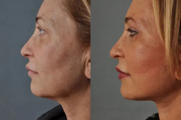 before and after facial fat grafting left side view female patient case 1777