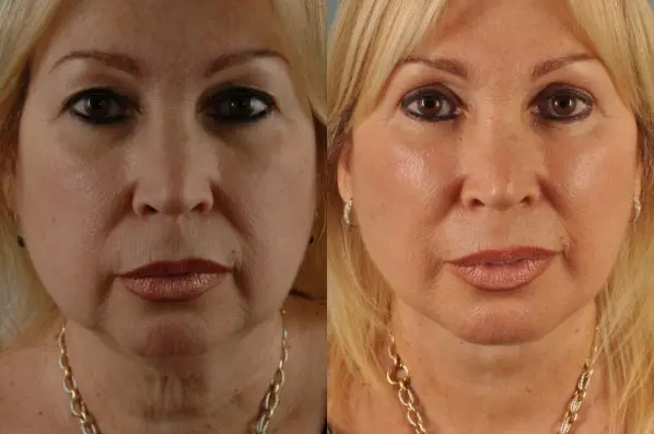 before and after facial fat grafting front view female patient case 1792