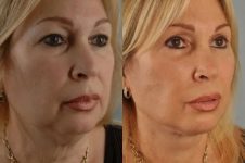 before and after facial fat grafting right angle view female patient case 1792