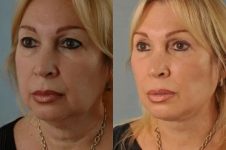 before and after facial fat grafting left angle view female patient case 1792