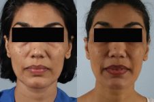 before and after facial fat grafting front view female patient case 1798
