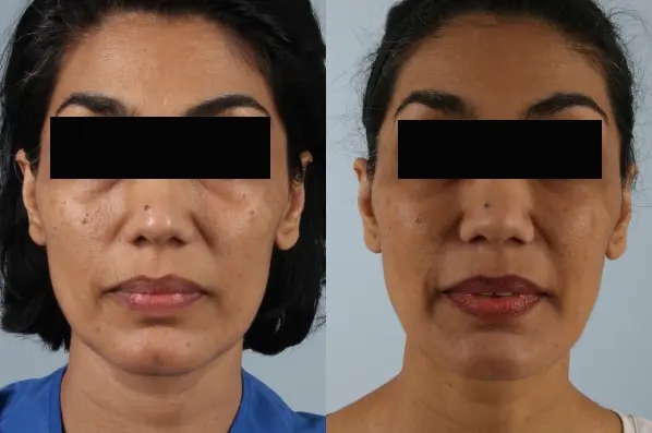 before and after facial fat grafting front view female patient case 1798