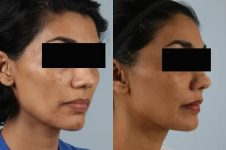 before and after facial fat grafting right angle view female patient case 1798