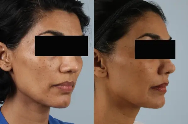 before and after facial fat grafting right angle view female patient case 1798