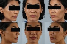 before and after facial fat grafting multiple view female patient case 1798