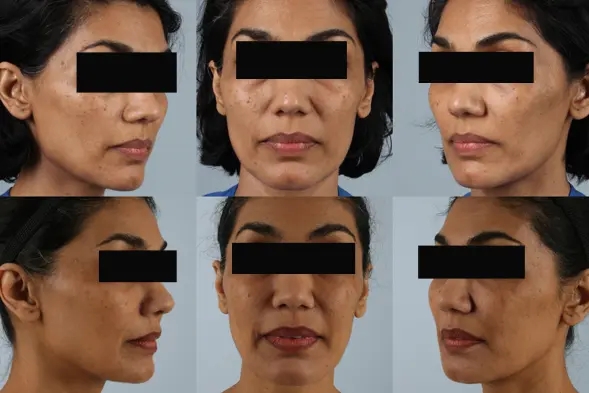 before and after facial fat grafting multiple view female patient case 1798