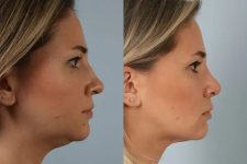 before and after facial fat grafting right side view female patient case 1824