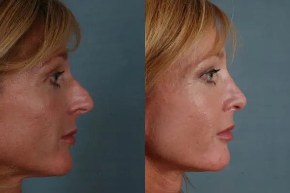 before and after facial fat grafting right side view female patient case 1833