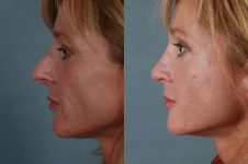 before and after facial fat grafting left side view female patient case 1833