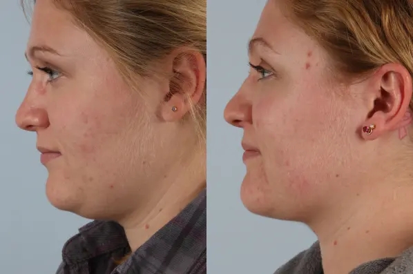 before and after facial fat grafting left side view female patient case 1838