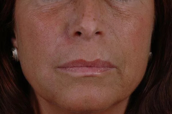 before and after facial rejuvenation front closeup view female patient case 1966