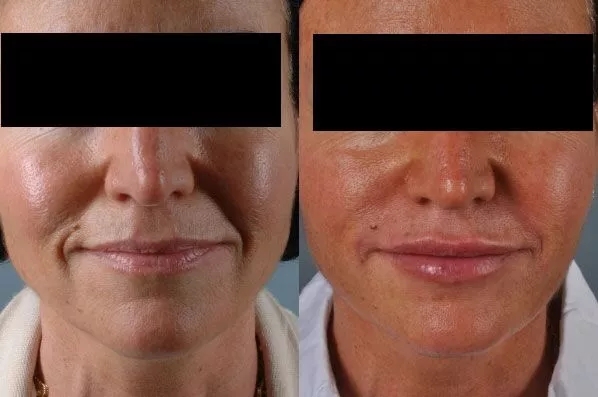 before and after filler front view female patient case 1982