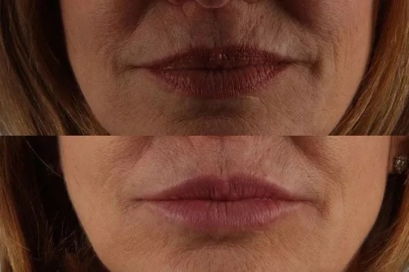 before and after filler front view female patient case 1996