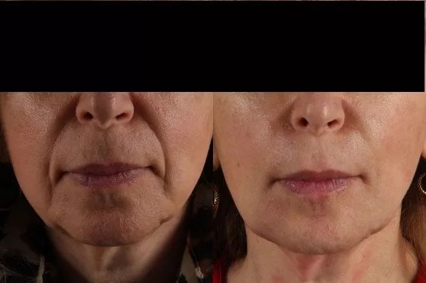 before and after facial rejuvenation front view female patient case 2002