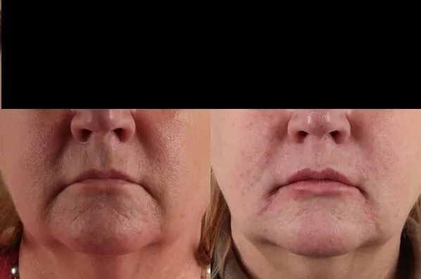 before and after facial rejuvenation front view female patient case 2005