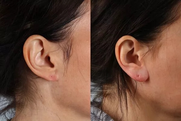before and after fillers right side view female patient case 2008