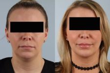 before and after facial rejuvenation front view female patient case 2011