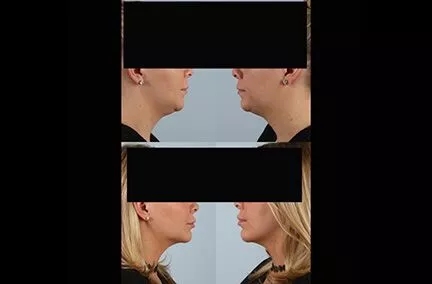 before and after facial rejuvenation side view female patient case 2011