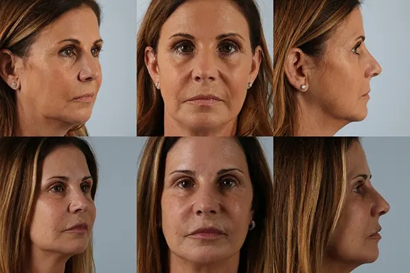 before and after facial rejuvenation front and side view female patient case 2016