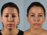 before and after fillers front view female patient case 2031