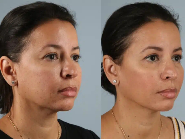 before and after fillers right view female patient case 2031