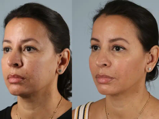 before and after fillers left view female patient case 2031
