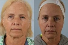 before and after facial rejuvenation female patient front view case 1958