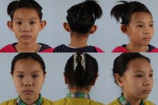 before and after otoplasty front back right view female patient case 1648