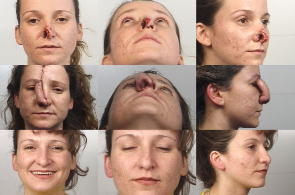 before and after rhinoplasty female patient multiple angle view case 3593