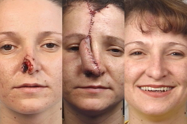 before and after rhinoplasty female patient front view case 3593