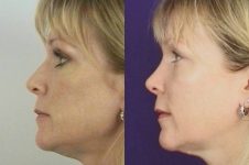 before and after rhinoplasty female patient left side view case 3597