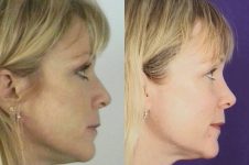 before and after rhinoplasty female patient right side view case 3597