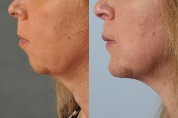 before and after rhinoplasty female patient left side view case 3620