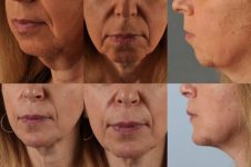 before and after rhinoplasty female patient multiple angle view case 3620