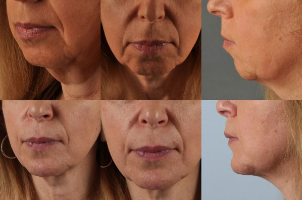 before and after rhinoplasty female patient multiple angle view case 3620