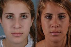 before and after rhinoplasty female patient front view case 3633