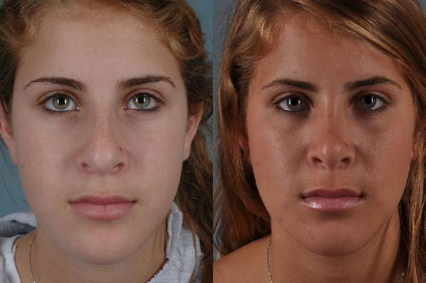 before and after rhinoplasty female patient front view case 3633