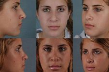 before and after rhinoplasty female patient multiple angle view case 3633