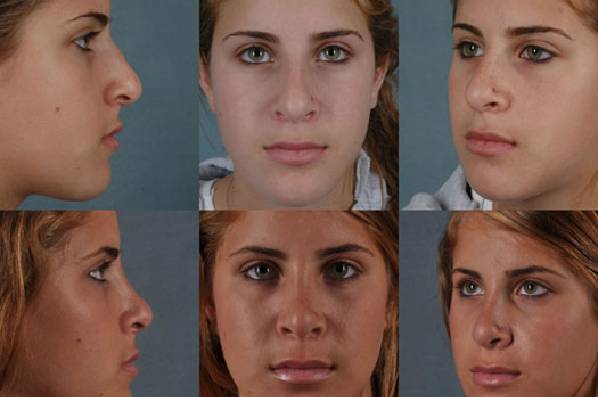 before and after rhinoplasty female patient multiple angle view case 3633